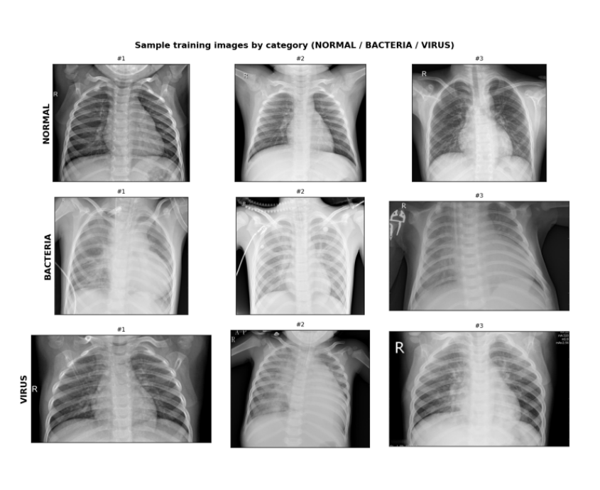 Pneumonia Classification preview image